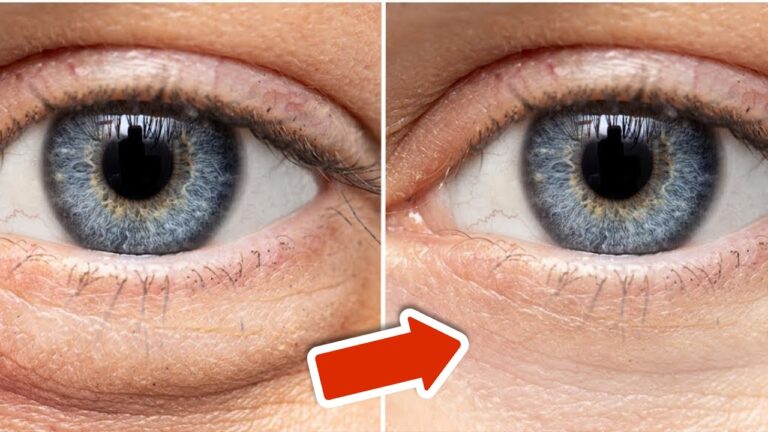 Geschwollene Augen in nur 20 Minuten loswerden – So gelingt’s einfach und schnell!