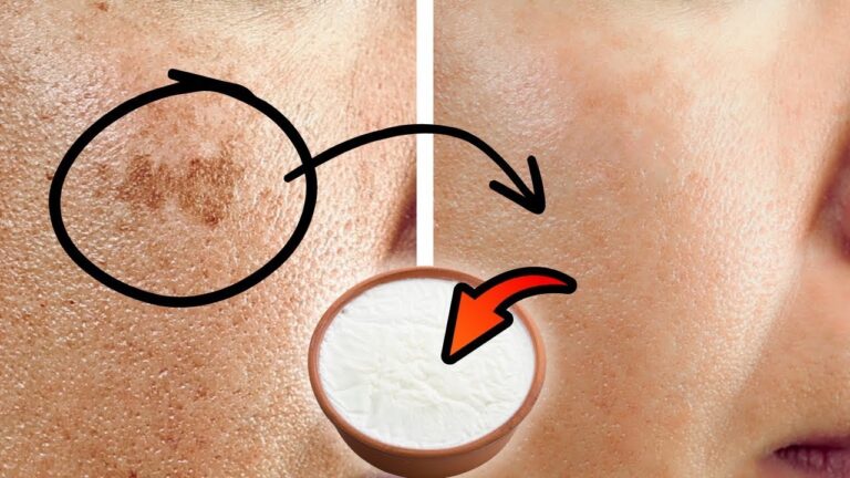 5 einfache Tipps gegen Altersflecken mit einem überraschenden Küchentrick!