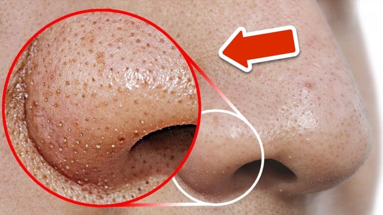 7 geniale Tricks zur blitzschnellen Entfernung von Mitessern auf der Nase!